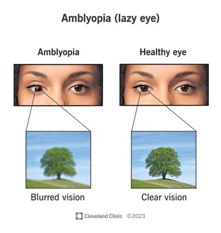 Mike Vrabel Eye Injury – Does He Have Amblyopia? |